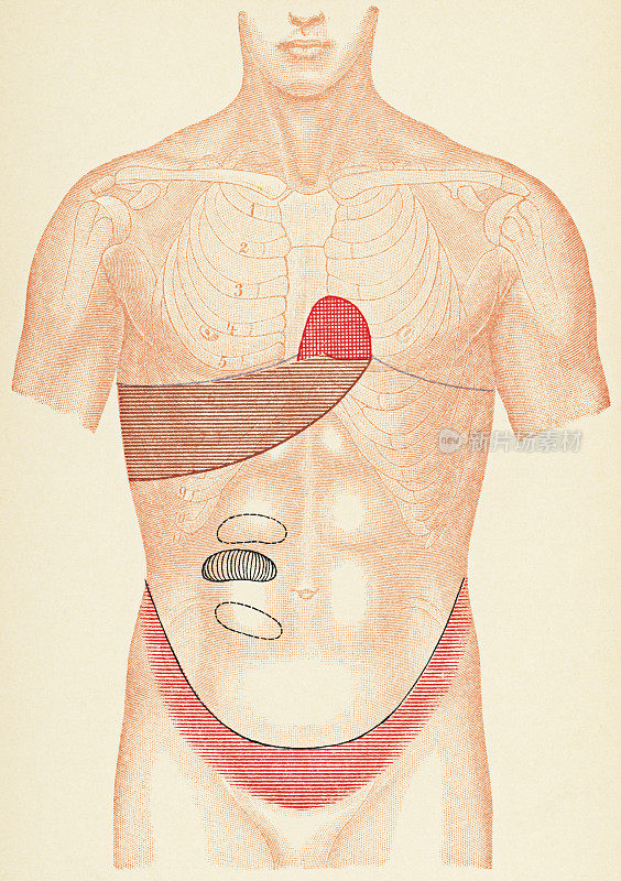人体躯干的医学插图与打击乐考试点的一个病人与肠梗阻,正面视图- 19世纪